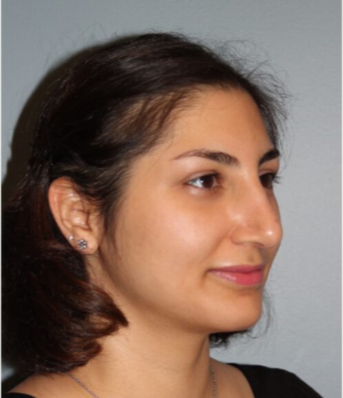 After — 28 year old woman treated with Nose Surgery