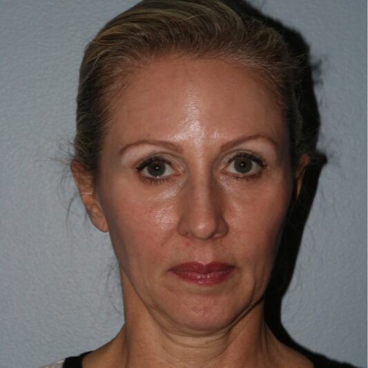 Before — 45-54 year old woman treated with Facelift