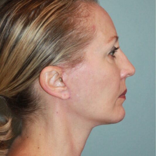After — 50 year old woman treated with Facelift