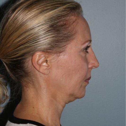 Before — 50 year old woman treated with Facelift
