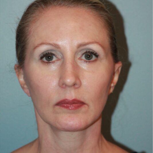 After — 50 year old woman treated with Lifestyle Lift