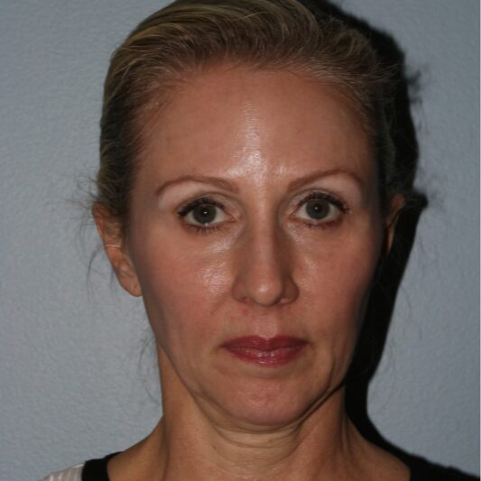 Before — 50 year old woman treated with Lifestyle Lift