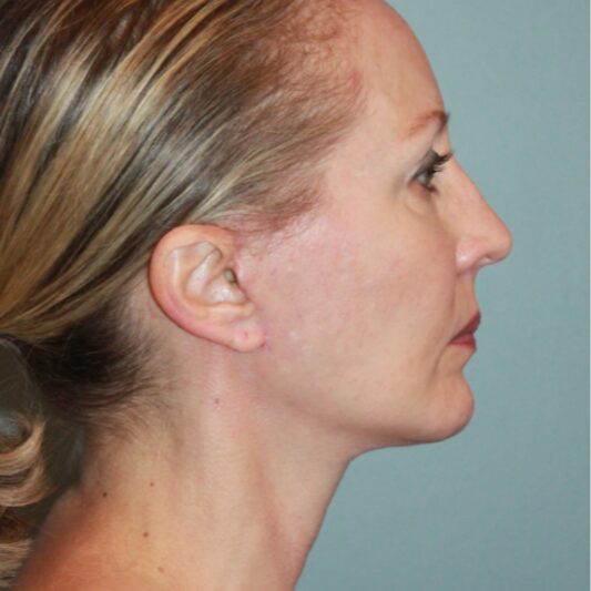 After — 50 year old woman treated with Lifestyle Lift