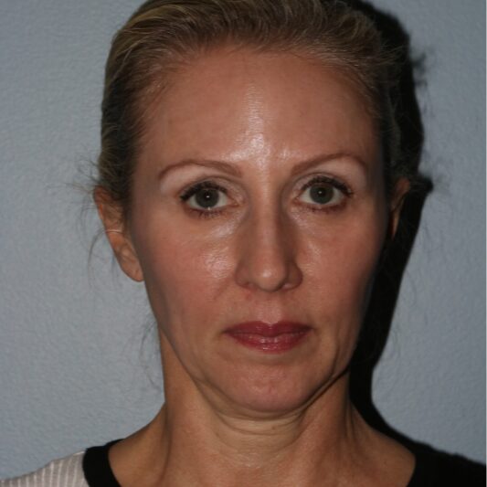 Before — 50 year old woman treated with SMAS Facelift