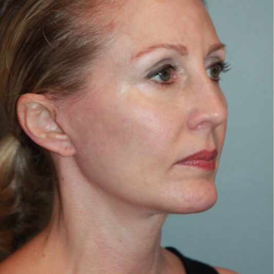After — 50 year old woman treated with Lower Face Lift