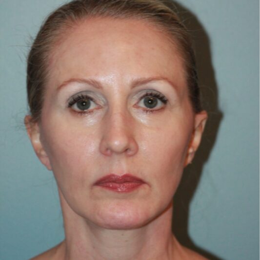 After — 50 year old woman treated with Lower Face Lift