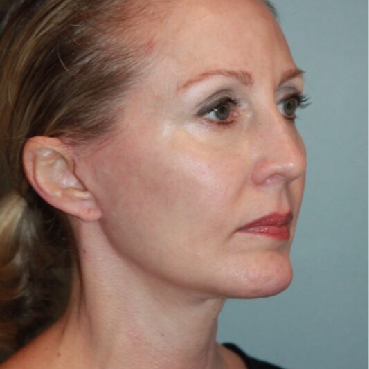 After — 50 year old woman treated with MACS Facelift