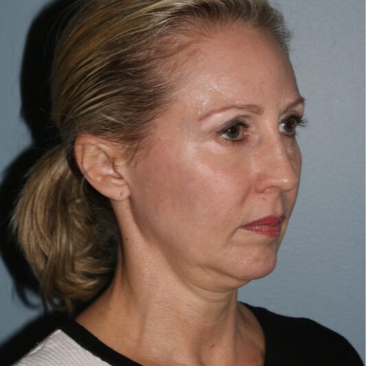 Before — 50 year old woman treated with MACS Facelift