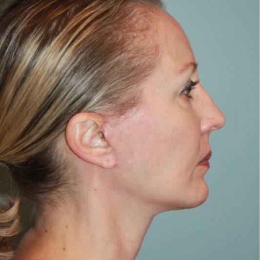 After — 50 year old woman treated with Chin Implant