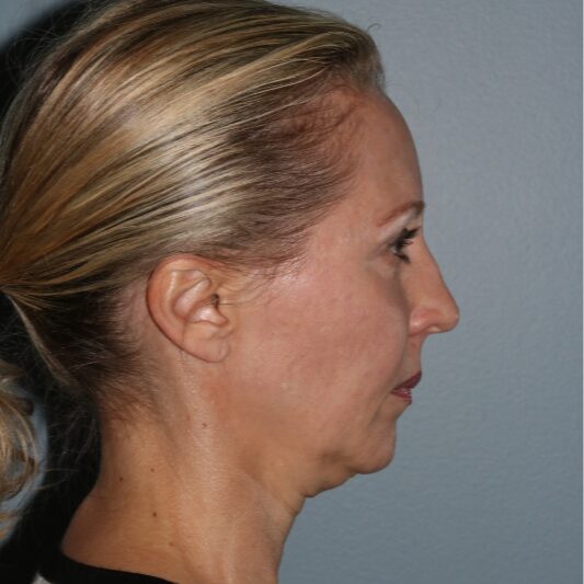 Before — 50 year old woman treated with Chin Implant
