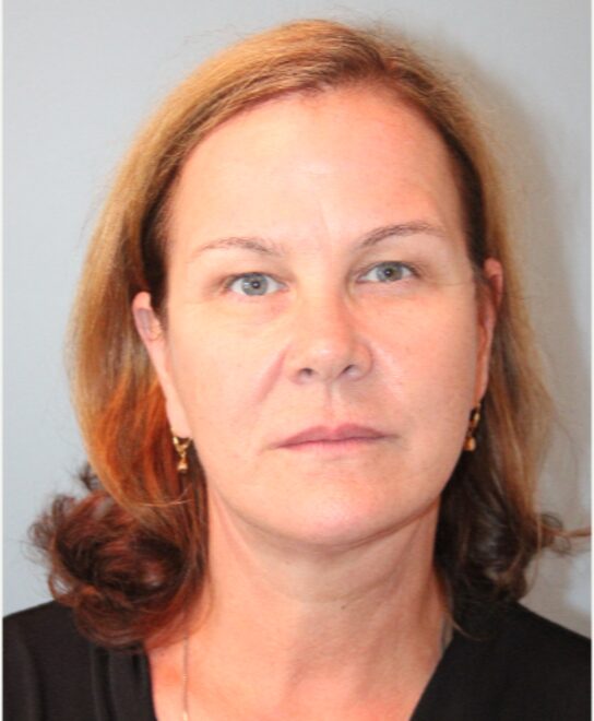 Before — 62 year old woman treated with Chin Liposuction