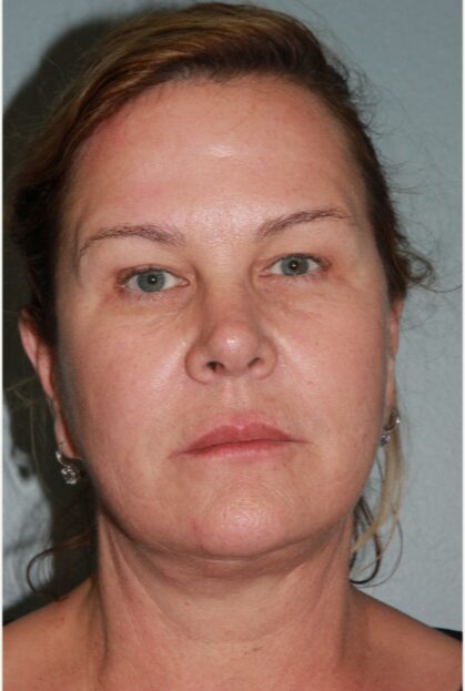 After — 62 year old woman treated with Deep Plane Facelift