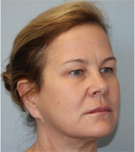 After — 62 year old woman treated with Deep Plane Facelift