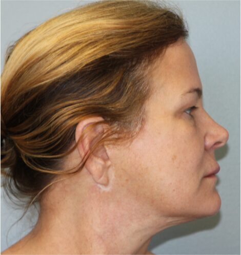 After — 62 year old woman treated with Deep Plane Facelift