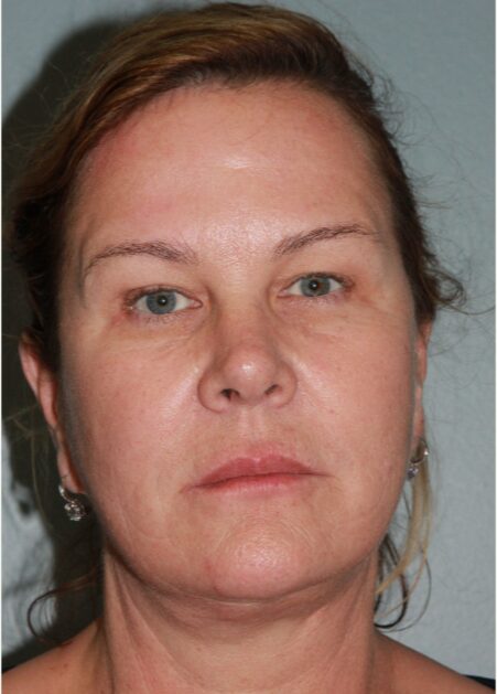 After — 62 year old woman treated with Lifestyle Lift