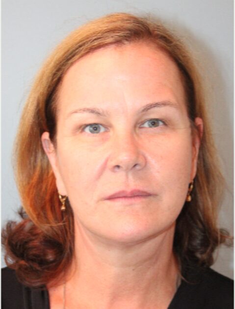 Before — 62 year old woman treated with Lifestyle Lift