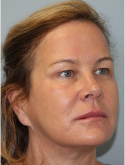 After — 62 year old woman treated with Lifestyle Lift