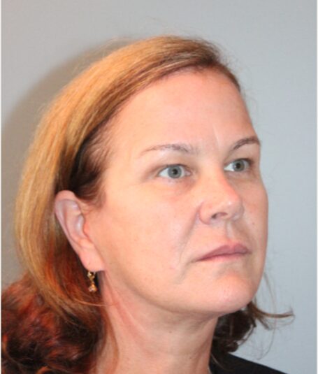 Before — 62 year old woman treated with Lifestyle Lift