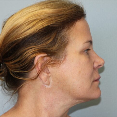 After — 62 year old woman treated with Lifestyle Lift