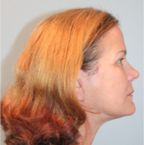 Before — 62 year old woman treated with Lifestyle Lift