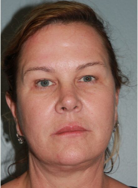 After — 62 year old woman treated with Lower Face Lift