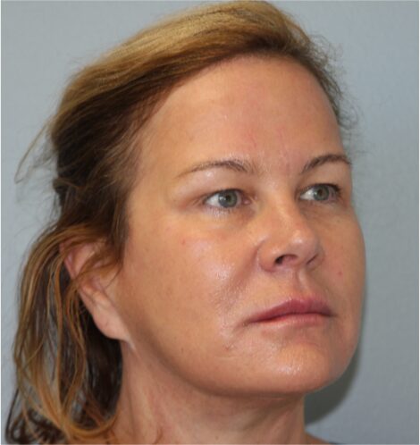 After — 62 year old woman treated with MACS Facelift