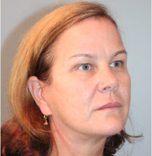 Before — 62 year old woman treated with MACS Facelift