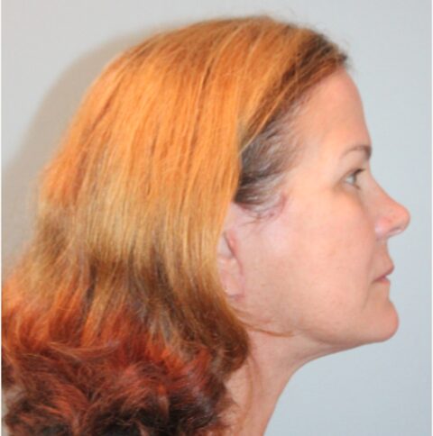 Before — 62 year old woman treated with MACS Facelift
