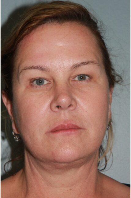 After — 62 year old woman treated with Neck Lift