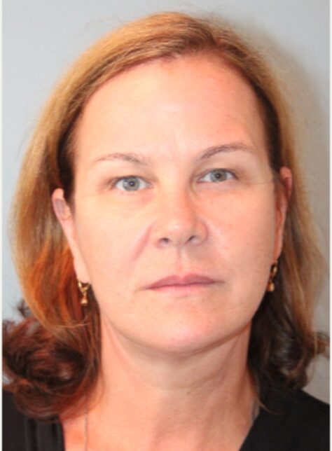 Before — 62 year old woman treated with Neck Lift