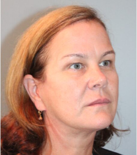 Before — 62 year old woman treated with Neck Lift