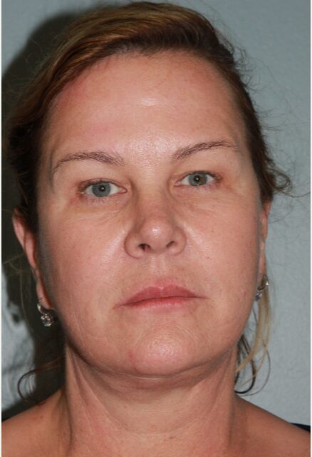 After — 62 year old woman treated with Quick Lift
