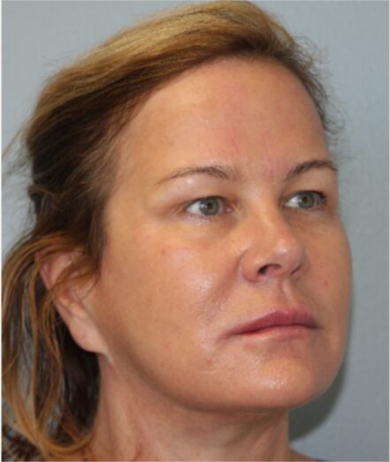 After — 55-64 year old woman treated with SMAS Facelift
