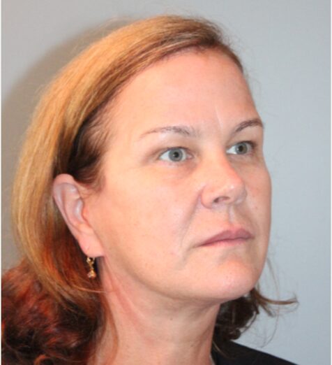 Before — 55-64 year old woman treated with SMAS Facelift