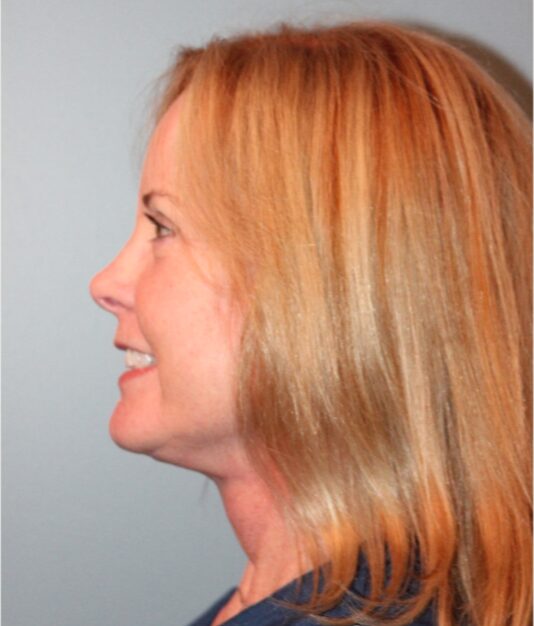 After — 62 year old woman treated with Deep Plane Facelift