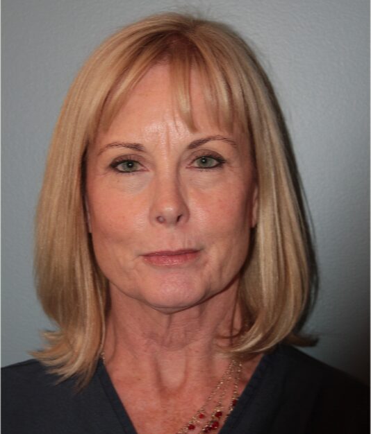 Before — 62 year old woman treated with Eyelid Surgery