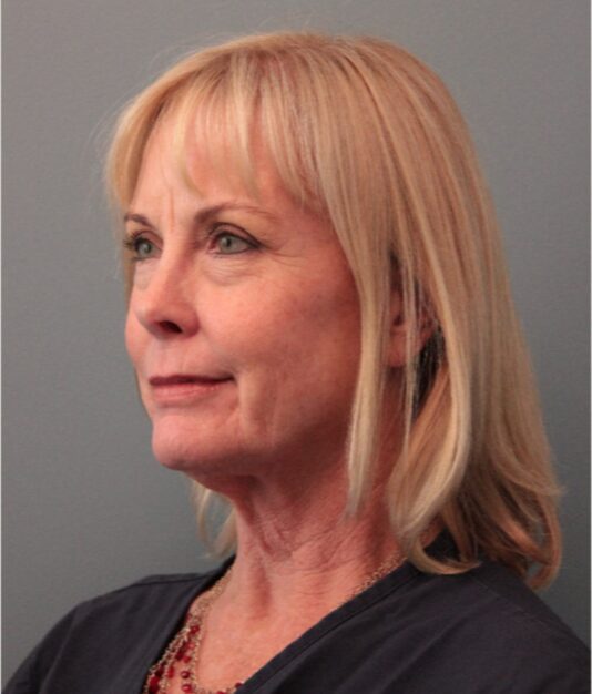 Before — 62 year old woman treated with Double Eyelid Surgery