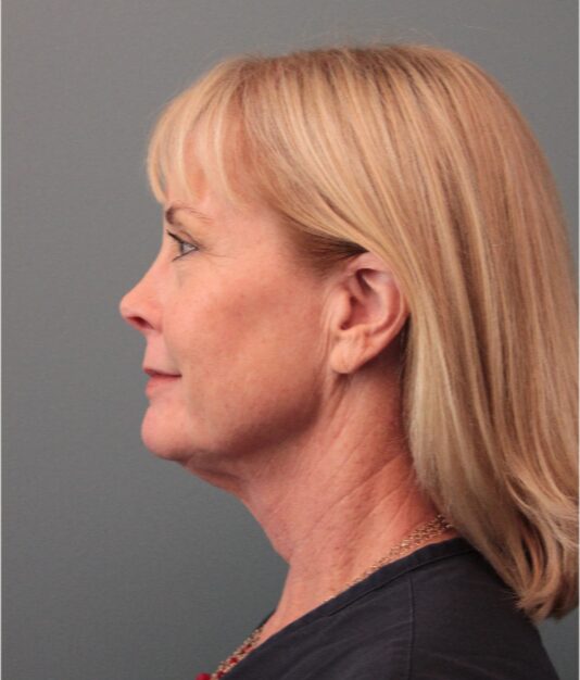 Before — 62 year old woman treated with Double Eyelid Surgery