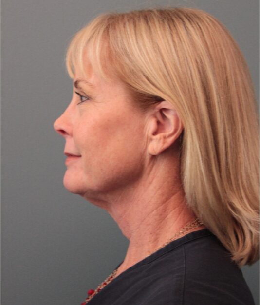 Before — 62 year old woman treated with Eyelid Surgery