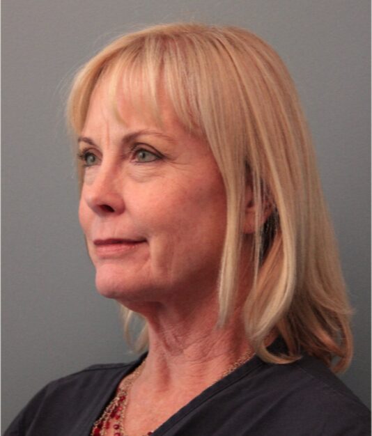 Before — 62 year old woman treated with Facelift
