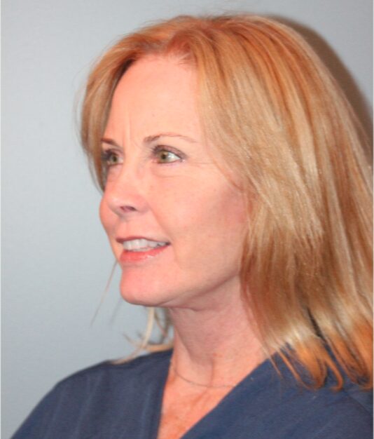 After — 62 year old woman treated with Lower Face Lift