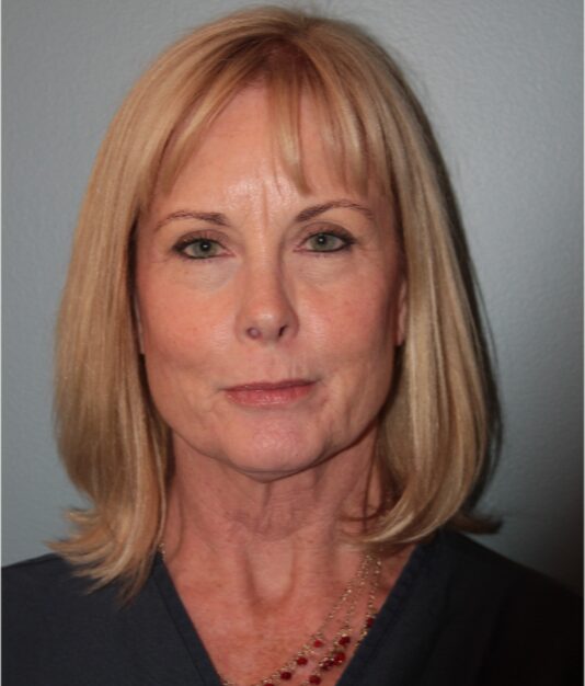 Before — 62 year old woman treated with MACS Facelift