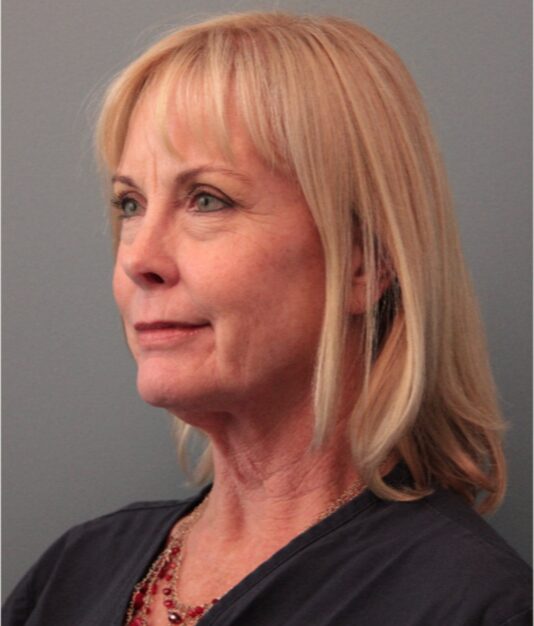 Before — 62 year old woman treated with MACS Facelift
