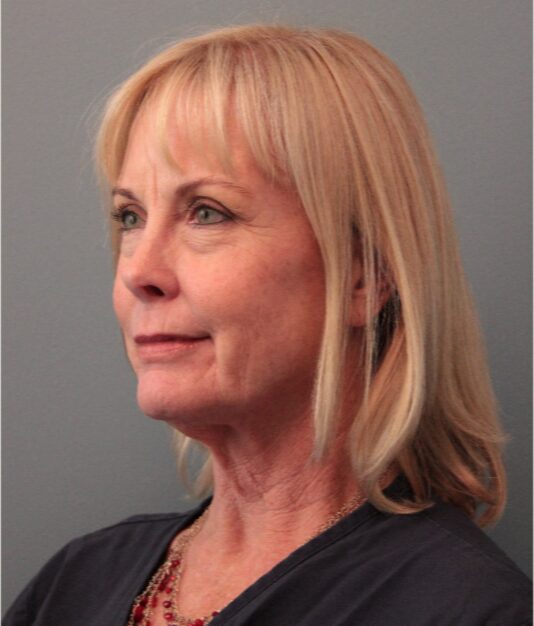 Before — 62 year old woman treated with Mini Lift