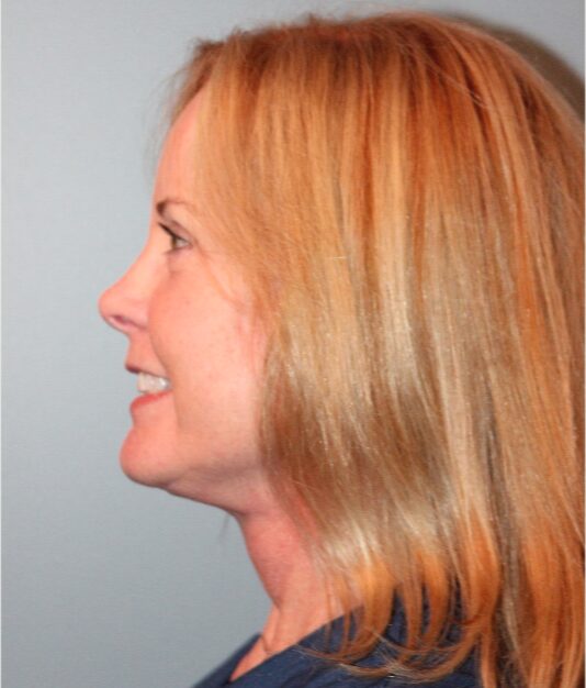 After — 62 year old woman treated with Mini Lift