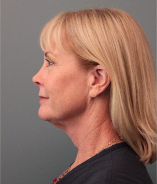 Before — 62 year old woman treated with Mini Lift