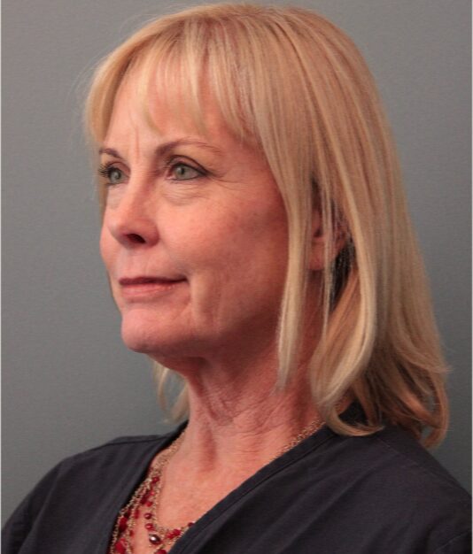 Before — 62 year old woman treated with SMAS Facelift