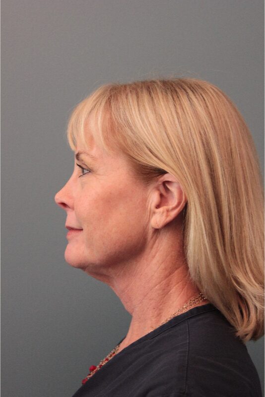 Before — 62 year old woman treated with SMAS Facelift