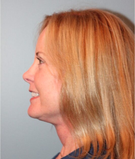 After — 62 year old woman treated with SMAS Facelift