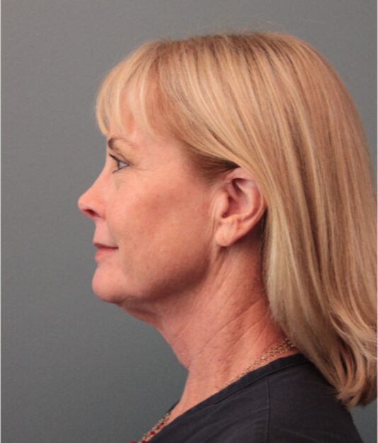 Before — 62 year old woman treated with SMAS Facelift